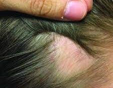 Best hair Specialist in Lahore, hair clinic in lahore, doctor for hair loss, best treatment for hair loss