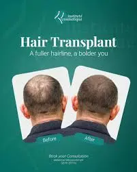 hair transplant