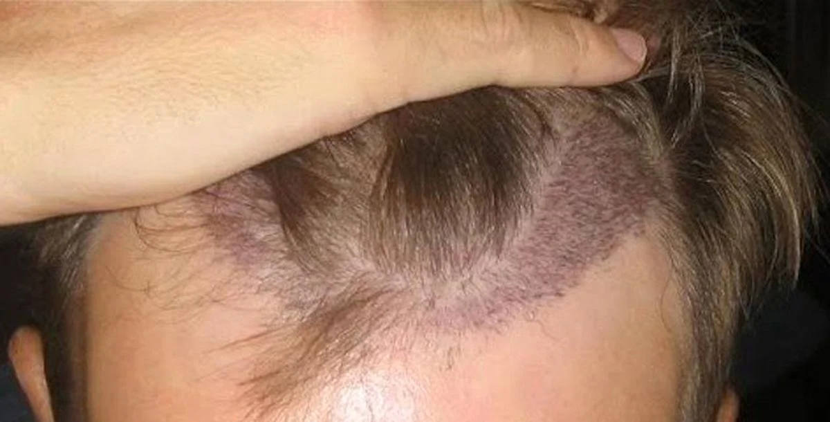 Best hair transplant in Lahore specialist designing natural hairline for patient