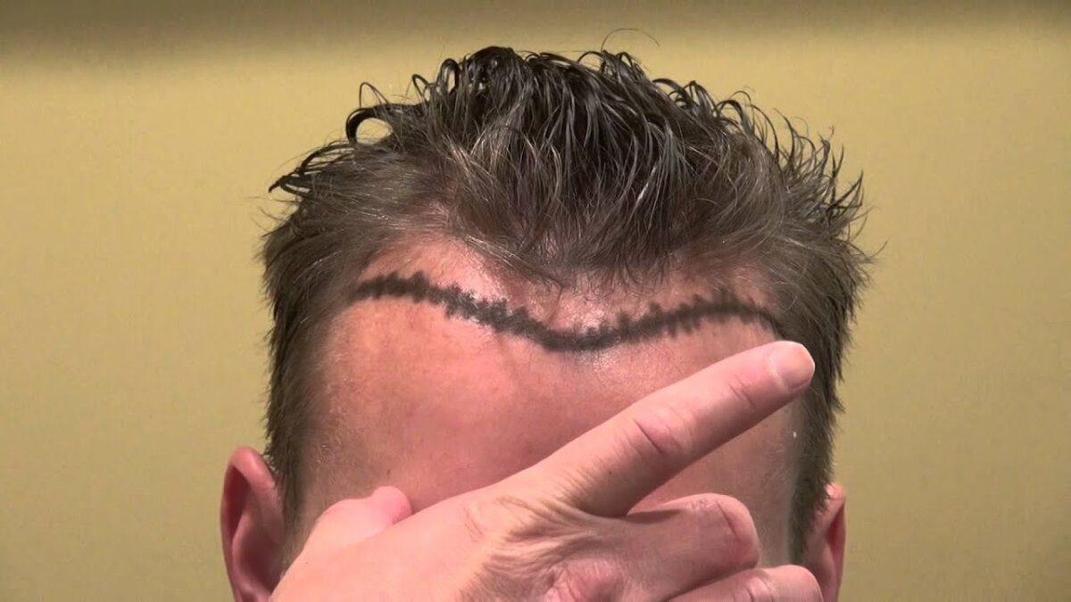 Specialist examining a patient's receding hairline before hair transplant consultation.