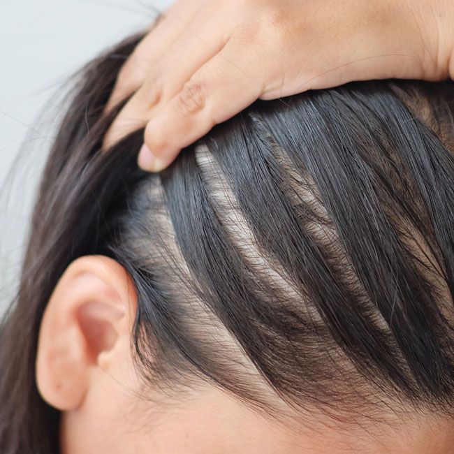 Hair thinning becoming more noticeable with expert hair restoration treatment