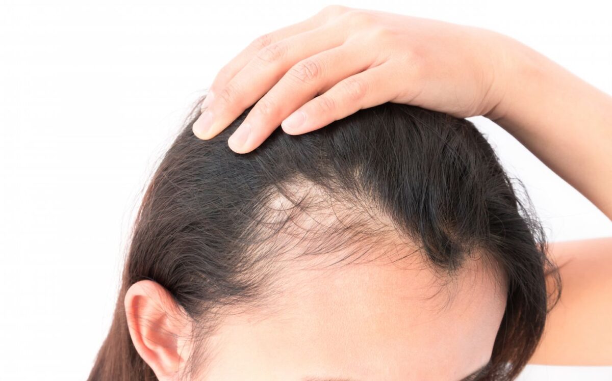 Hair transplant procedure showing healthy hair follicle restoration for natural growth and improved hair density.