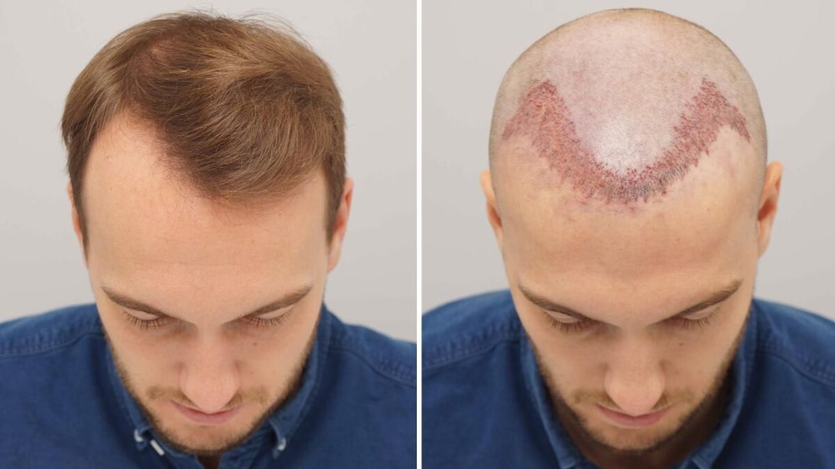 Surgeon examining scalp before hair transplant procedure in Lahore