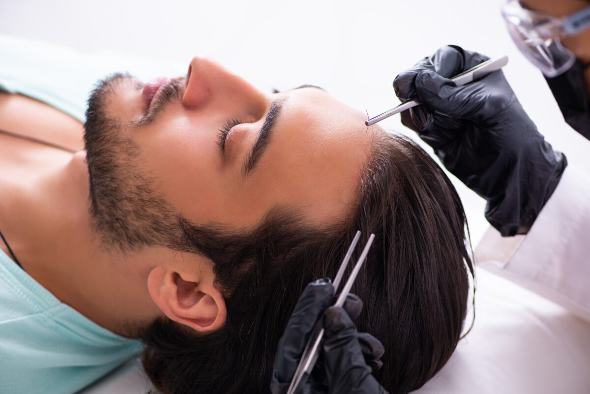 Close-up of hair follicle implantation during transplant