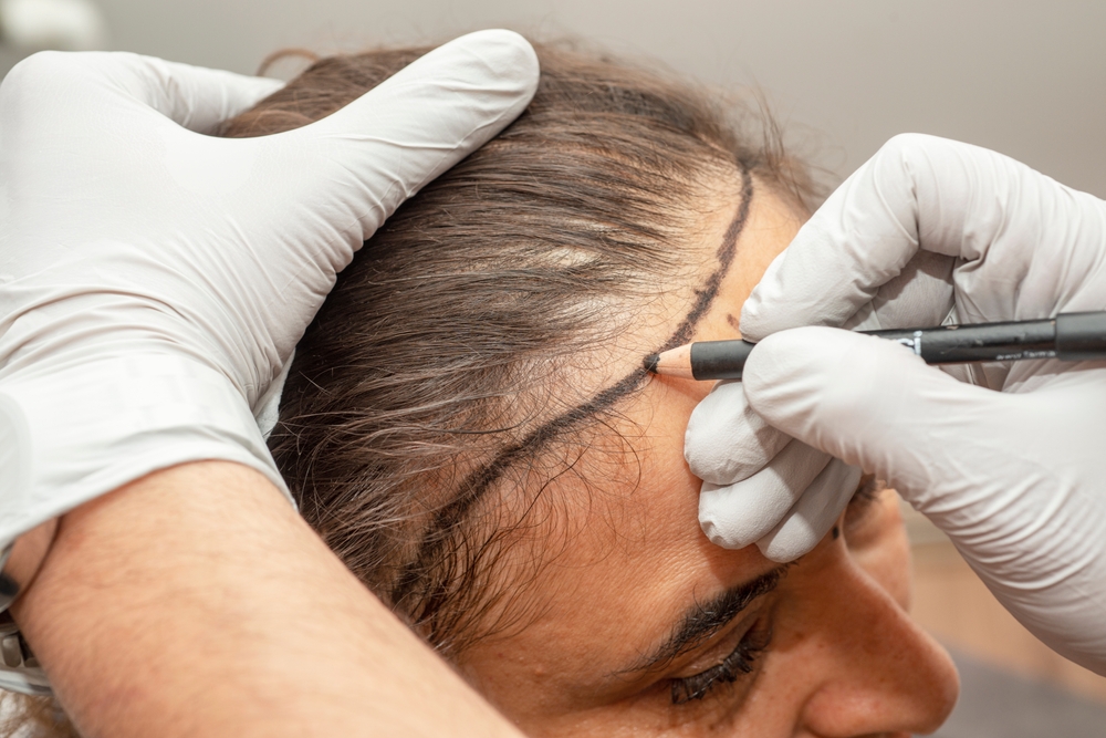 Specialist creating a personalized hair transplant plan after patient hair assessment.