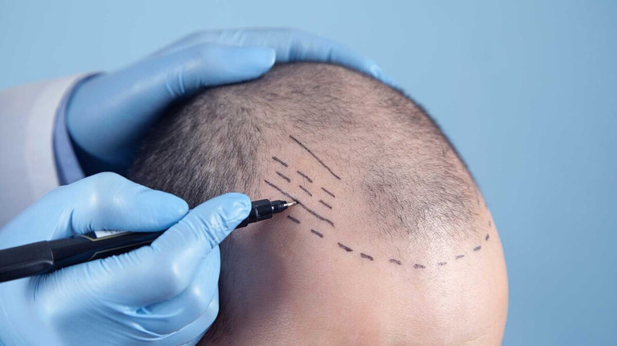 Hair transplant specialist performing a procedure to restore hair growth and improve hair density.