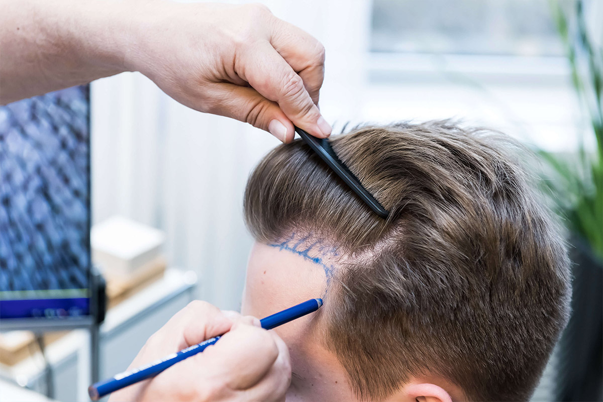 Hair transplant procedure for restoring natural hair growth