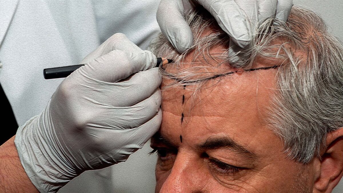 Hair transplant procedure showing common mistakes to avoid before and after surgery, including aftercare guidance and graft protection tips.