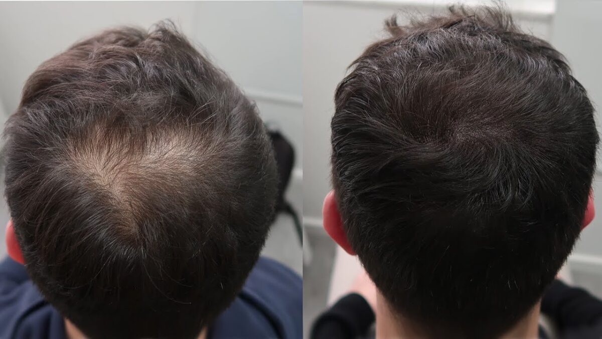 Hair transplant treatment helping turn thin hair into thicker, fuller, and natural-looking hair with improved density
