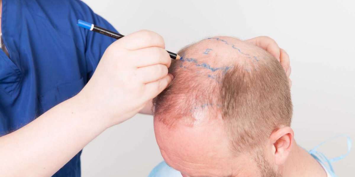 Hair follicle direction planning for natural hair transplant results