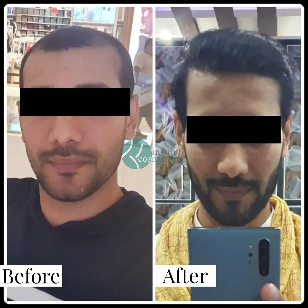 best-hair-transplant-clinic-results