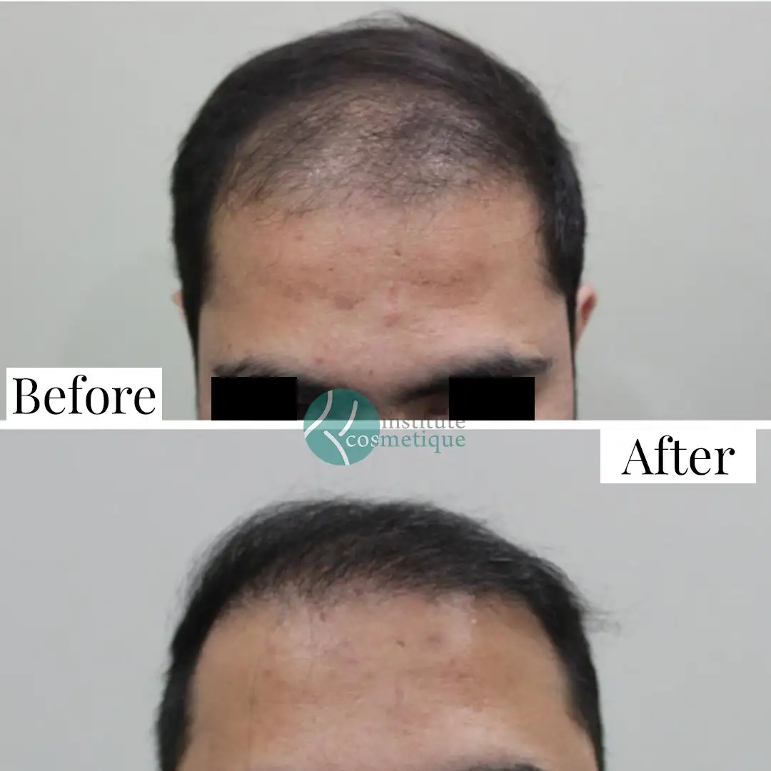 crown-hair-transplant-results