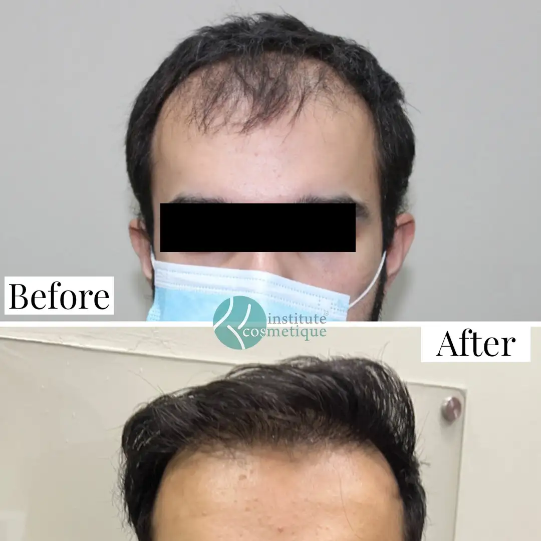 fue-hair-transplant-transformation