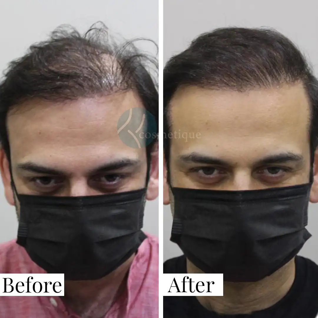hair-restoration-before-after