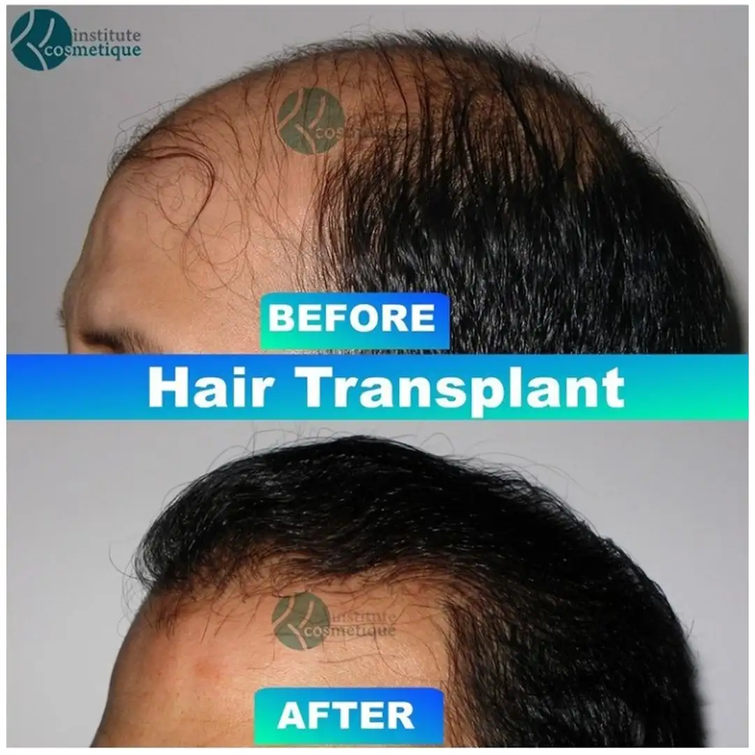 hair-transplant-before-after-results