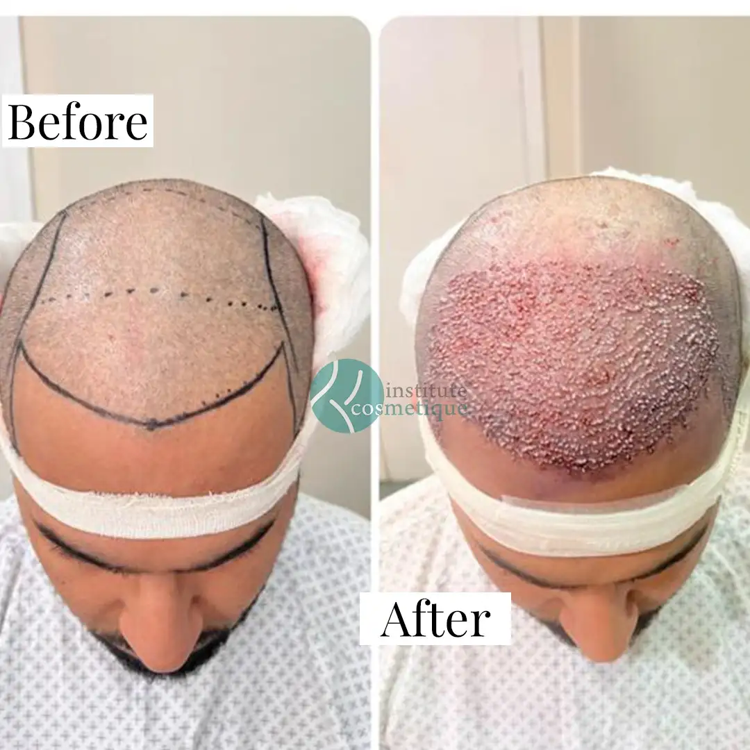 hair-transplant-clinical-results
