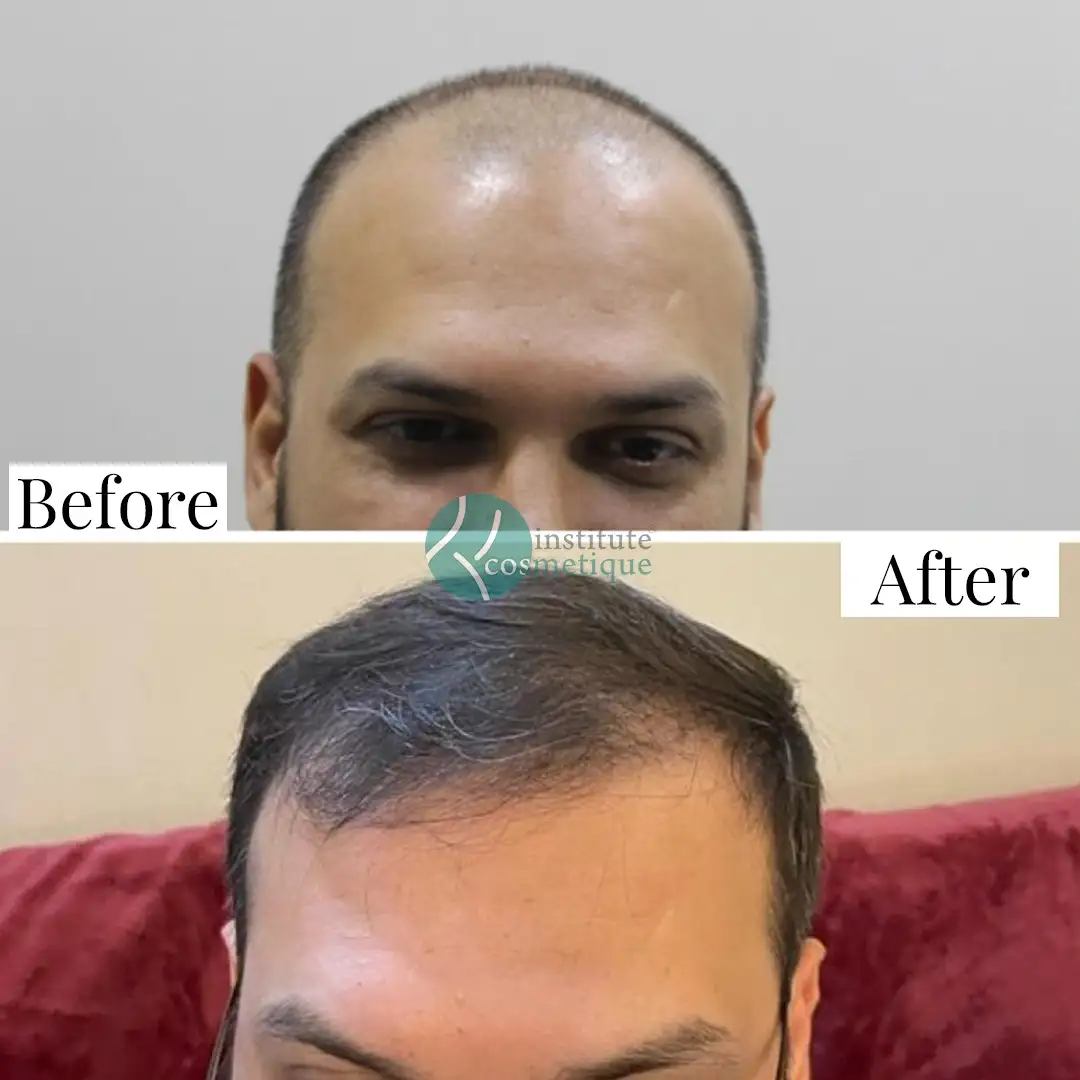 hair-transplant-coverage-results