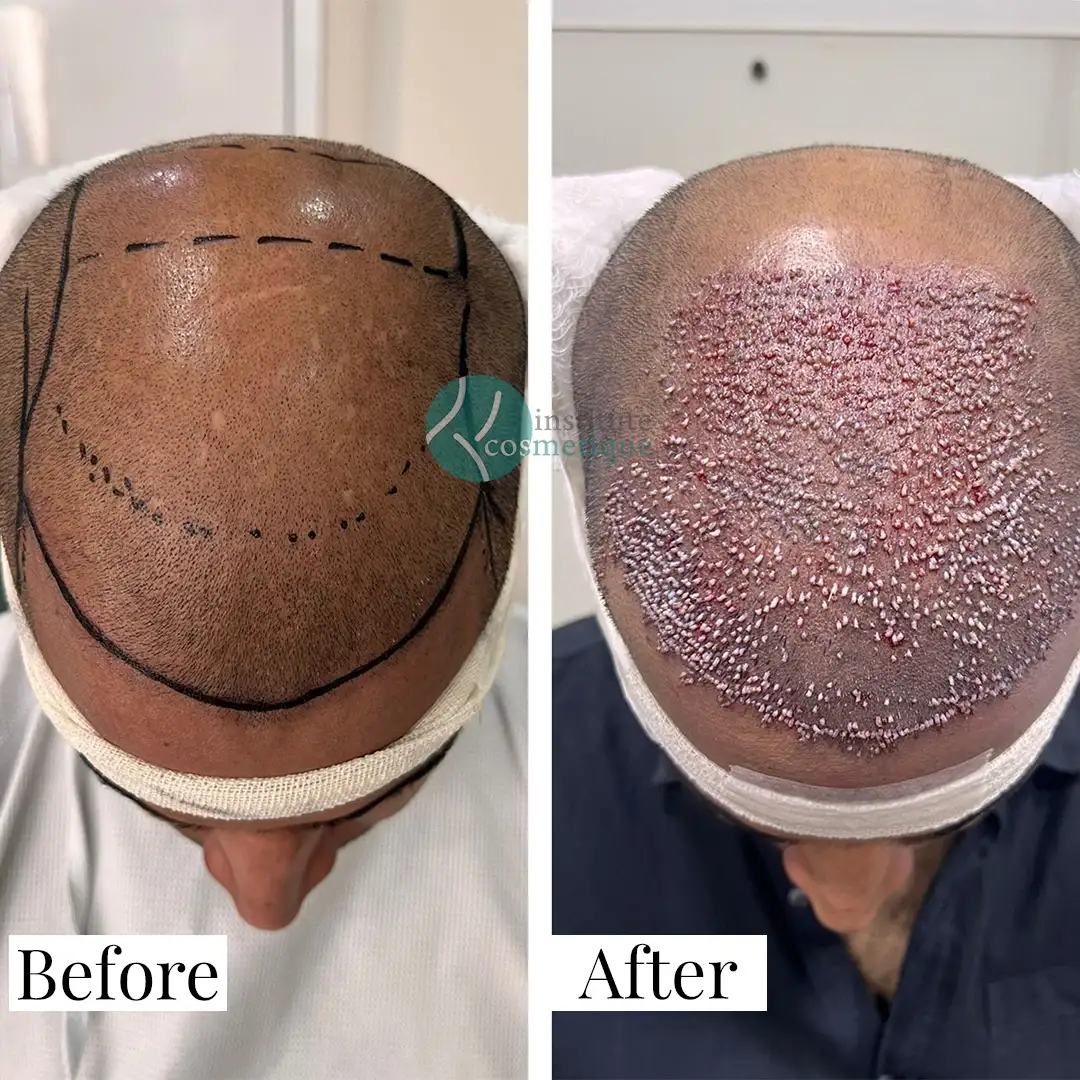 hair-transplant-growth-timeline