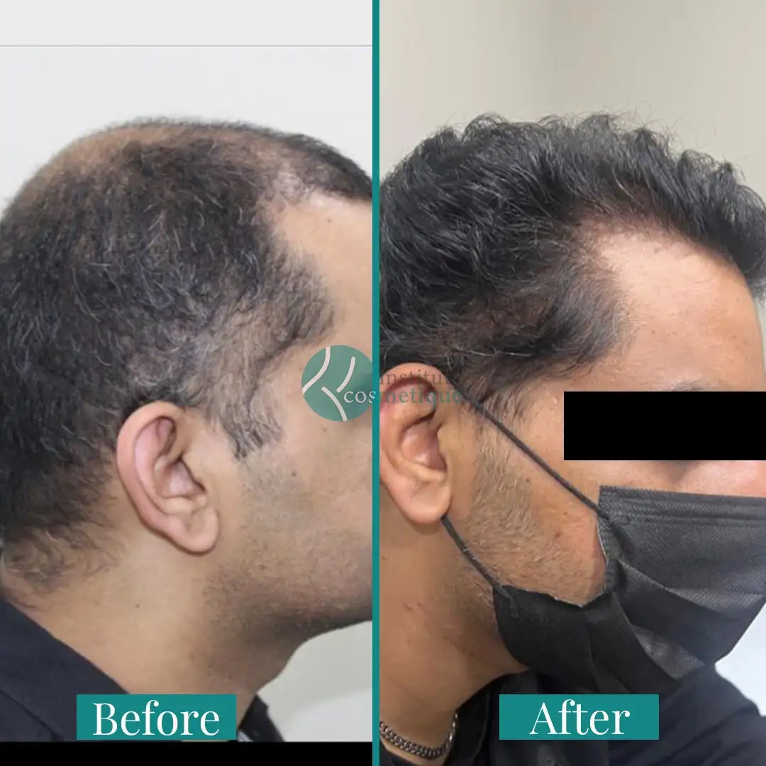 hair-transplant-new-hairline-results