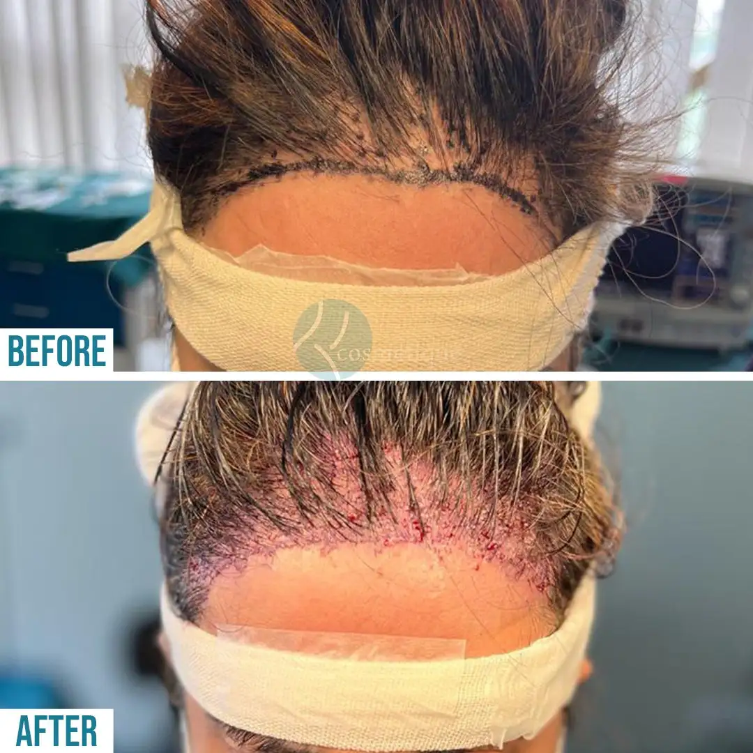 hair-transplant-real-patient-photos