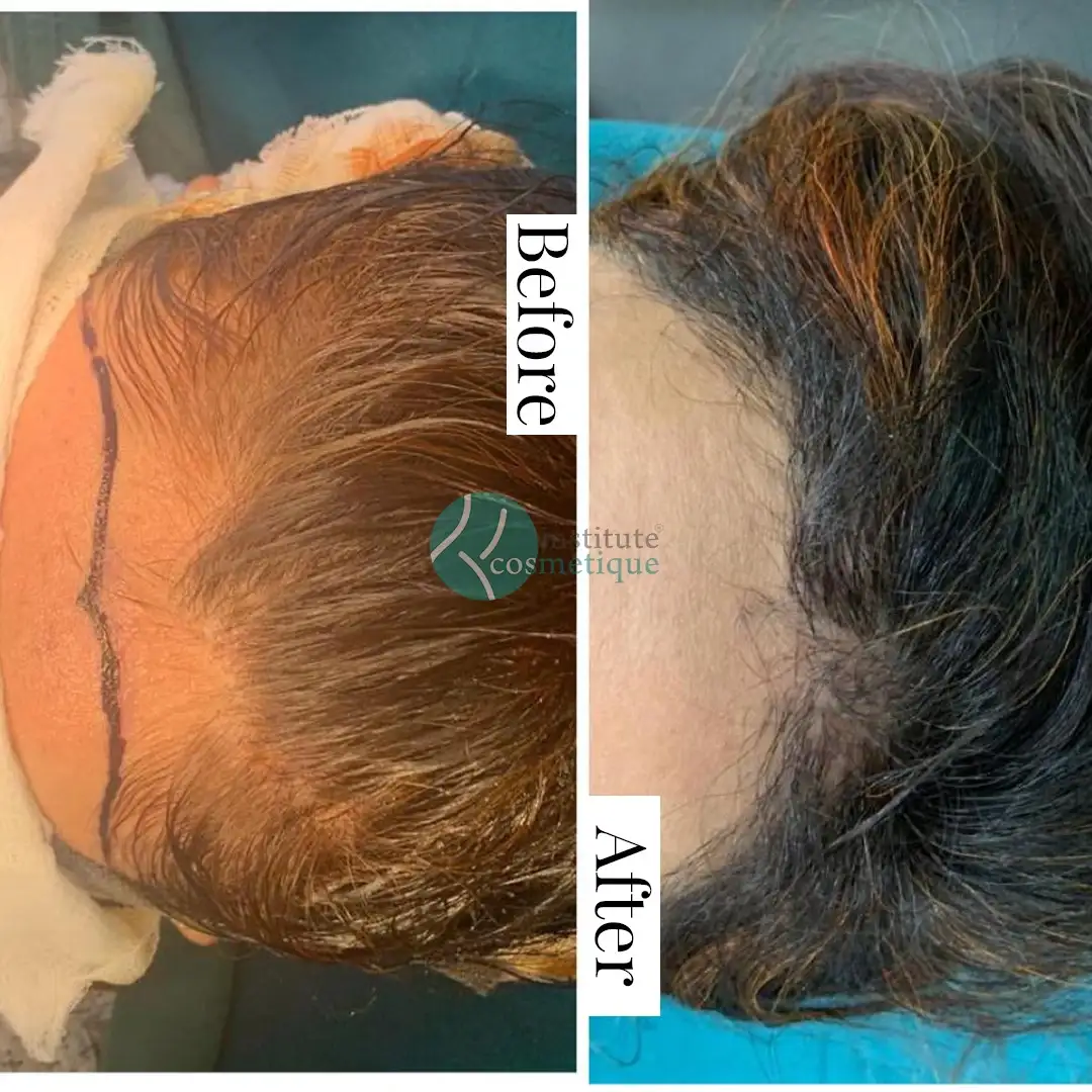 hair-transplant-satisfied-patient