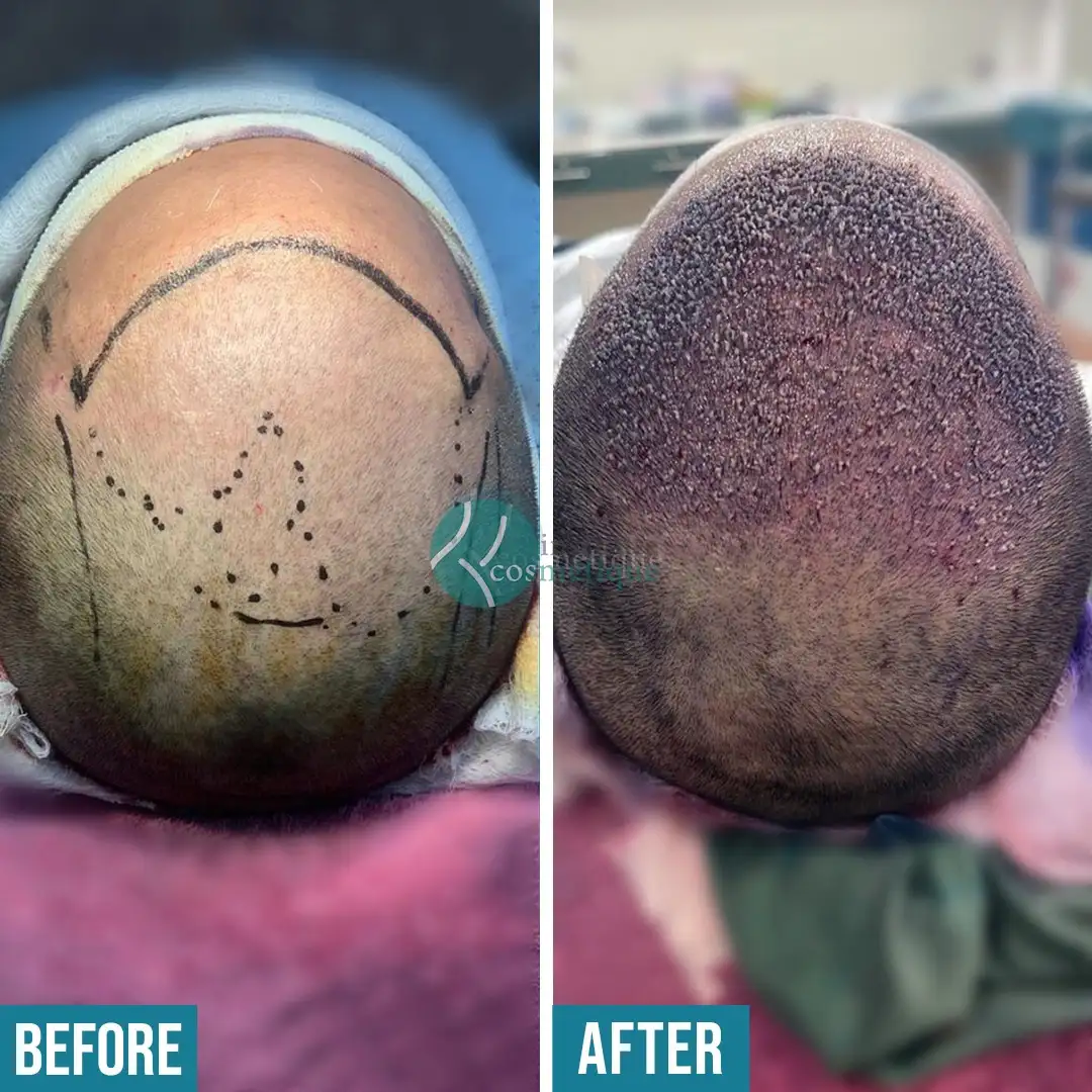hair-transplant-thickness-improvement