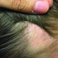 Best hair Specialist in Lahore, hair clinic in lahore, doctor for hair loss, best treatment for hair loss