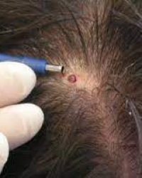 Best Warts Removal Treatment in Lahore